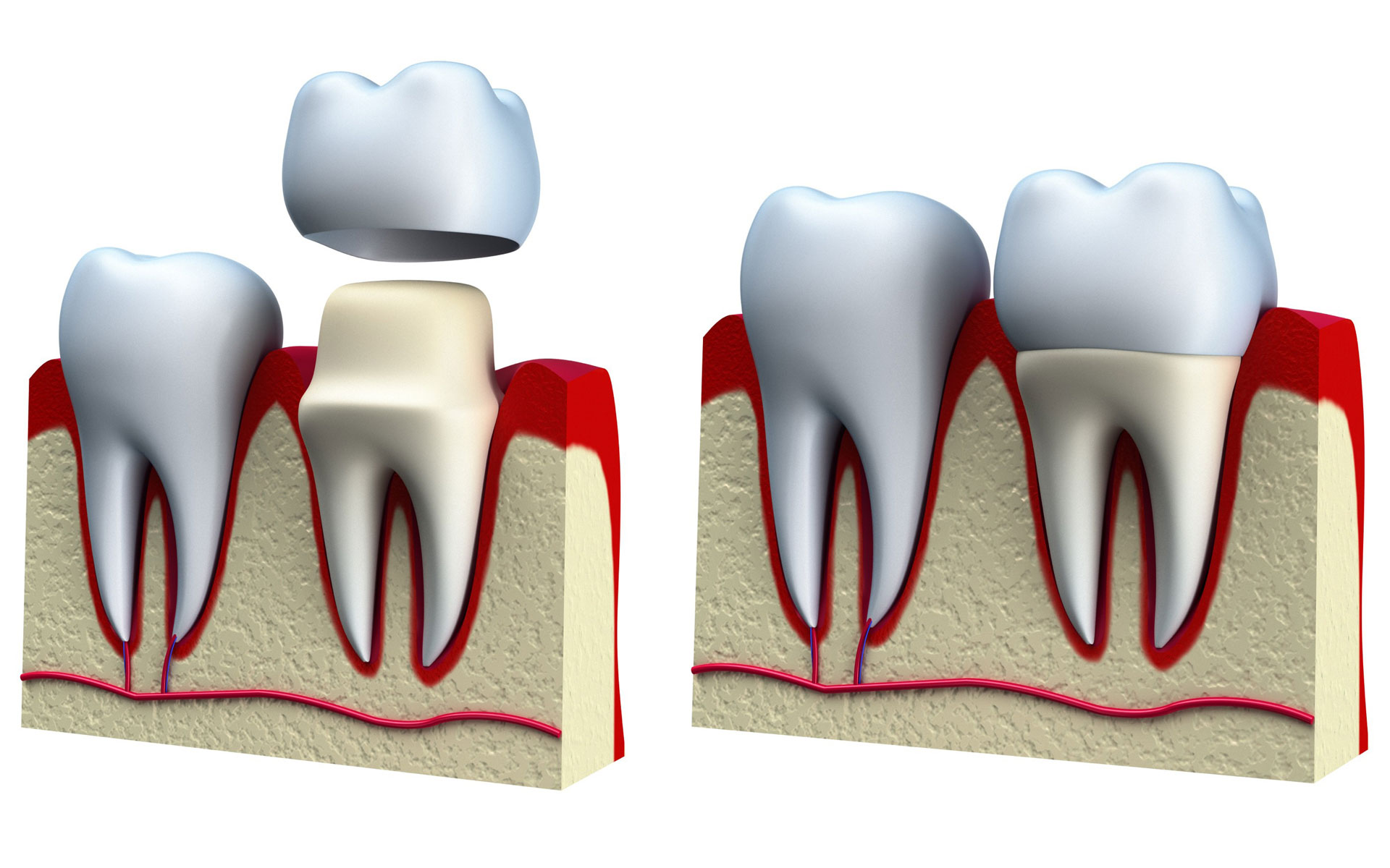 Dental Crown Downey - Your Downey Dentist